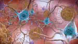 alzheimer