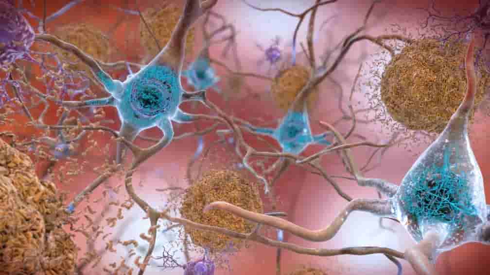 alzheimer