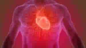 infarto